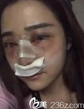 源<!--<i data=20240703-sp></i>-->萍做假體隆鼻手術(shù)案例 源<!--<i data=20240703-sp></i>-->萍做假體隆鼻手術(shù)案例