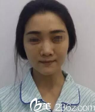 源<!--<i data=20240703-sp></i>-->萍做鼻綜合手術(shù)前 源<!--<i data=20240703-sp></i>-->萍做鼻綜合手術(shù)前