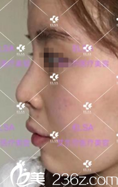 長春艾爾莎鼻綜合手術(shù)前 長春艾爾莎鼻綜合手術(shù)前