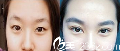 聊城韓美雙眼皮案例效果對比圖