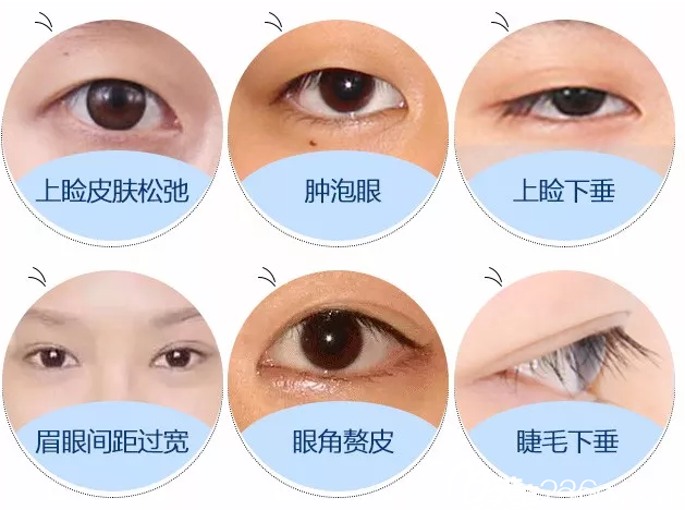 長(zhǎng)春艾爾莎眼綜合手術(shù)適合人群