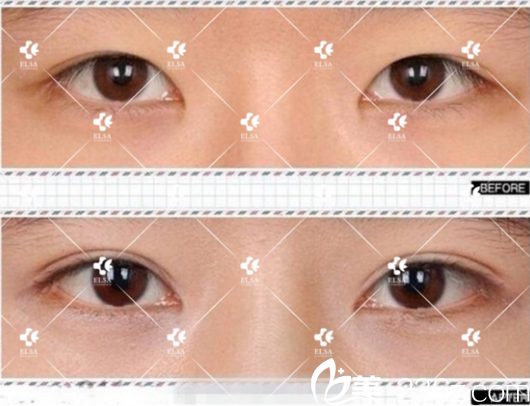 長(zhǎng)春艾爾莎眼綜合手術(shù)案例