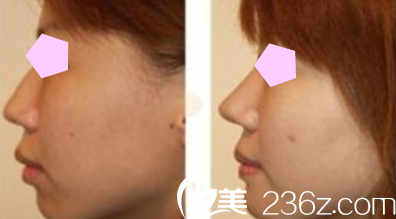 聊城韓美整形隆鼻案例效果圖