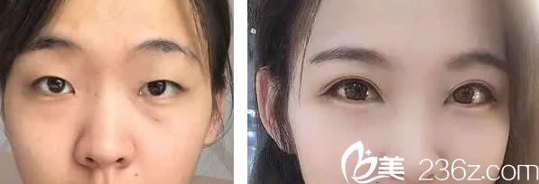 蘭州韓美雙眼皮+開眼角效果案例 蘭州韓美雙眼皮+開眼角效果案例