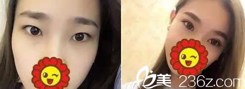 蘭州韓美全切雙眼皮+開眼角效果 蘭州韓美全切雙眼皮+開眼角效果