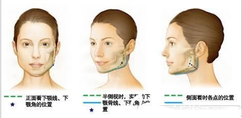 李斗榮美笑整形外科下頜角磨骨 李斗榮美笑整形外科下頜角磨骨