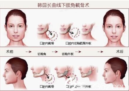 李斗榮美笑整形外科下頜角截骨 李斗榮美笑整形外科下頜角截骨