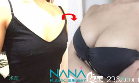 黃銅淵院長(zhǎng)復(fù)合隆胸前后效果案例