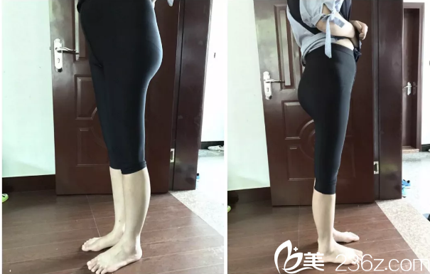 在韓國THE整形醫(yī)院做腿部吸脂第8天效果 在韓國THE整形醫(yī)院做腿部吸脂第8天效果