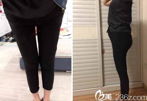 韓國THE整形外科醫(yī)院金洙喆腿部吸脂第13天效果 韓國THE整形外科醫(yī)院金洙喆腿部吸脂第13天效果