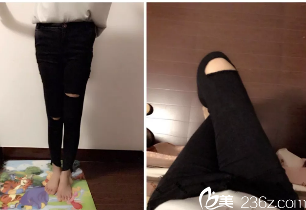 金洙喆腿部吸脂案例 金洙喆腿部吸脂案例