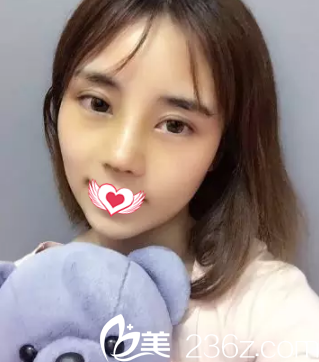 鼻綜合7天后鼻子慢慢消腫 鼻綜合7天后鼻子慢慢消腫