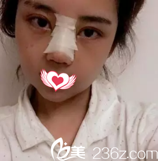 剛做完鼻綜合鼻子腫脹 剛做完鼻綜合鼻子腫脹