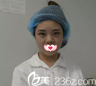 術(shù)前塌鼻 術(shù)前塌鼻