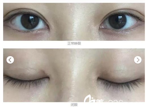廣州雙眼皮整形醫(yī)院哪家好