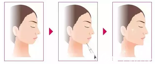 玻尿酸注射豐下巴原理