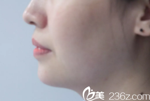 剛做完注射豐下巴術(shù)后即刻