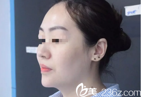 玻尿酸豐下巴需要幾針?南通儷人連天美先給你看注射2支術(shù)后三天恢復(fù)效果