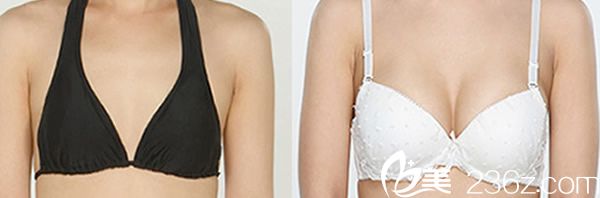 娜娜整形黃銅淵院長自體脂肪豐胸案例