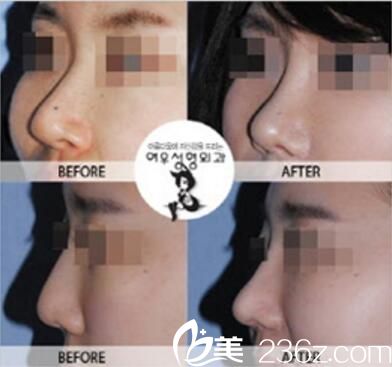 假體隆鼻真人前后對比 假體隆鼻真人前后對比