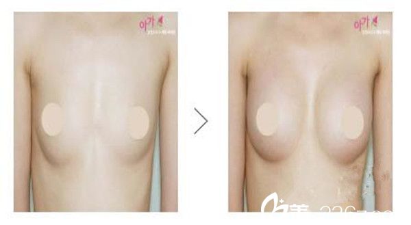 林景郁醫(yī)生隆胸案例分享 林景郁醫(yī)生隆胸案例分享
