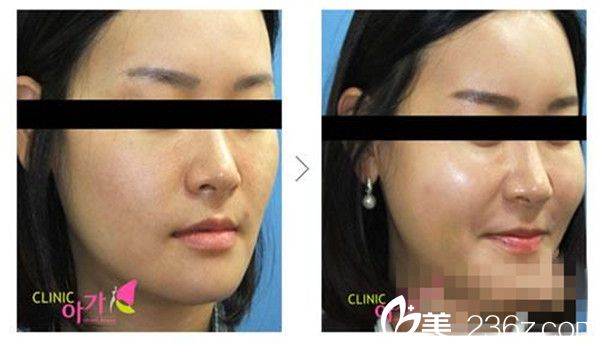 自體脂肪豐額頭案例分享 自體脂肪豐額頭案例分享