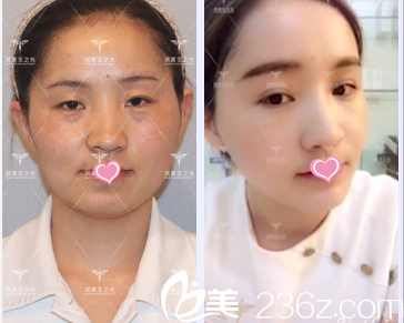 北京潤美玉之光面部脂肪填充雙眼皮 北京潤美玉之光面部脂肪填充雙眼皮