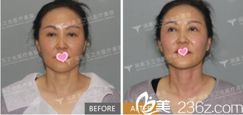 北京潤美玉之光去頸紋 北京潤美玉之光去頸紋