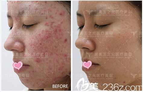 北京潤美玉之光祛痘 北京潤美玉之光祛痘