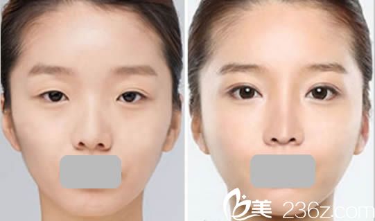 湛美整形雙眼皮案例對(duì)比圖 湛美整形雙眼皮案例對(duì)比圖