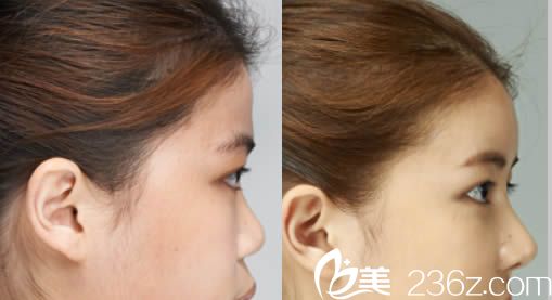 湛美醫(yī)療美容醫(yī)院玻尿酸隆鼻案例圖 湛美醫(yī)療美容醫(yī)院玻尿酸隆鼻案例圖