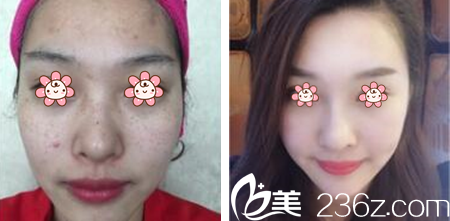 代曉蓉主任皮膚祛痘祛斑美容案例 代曉蓉主任皮膚祛痘祛斑美容案例