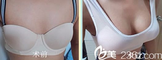 韓國娜娜整形外科隆胸前后效果對比案例