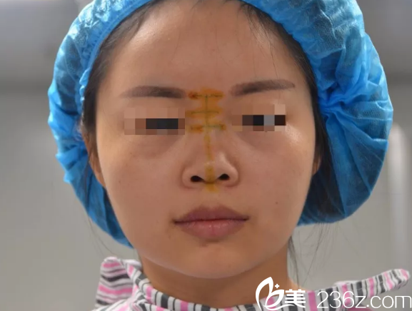 線雕隆鼻失敗鼻尖發(fā)紅找南通儷人連天美吳昌炎院長取出后做硅膠隆鼻+肋軟骨墊鼻尖鼻綜合修復(fù)