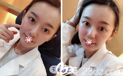 周業(yè)松面部線雕提升加玻尿酸填充蘋果肌術(shù)后第三天 周業(yè)松面部線雕提升加玻尿酸填充蘋果肌術(shù)后第三天