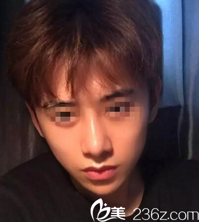 分享我找桂林時光美萊毛建文做鼻綜合手術(shù)1個月就恢復(fù)的超級自然