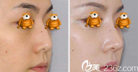 金亨俊院長(zhǎng)肋骨隆鼻改善鼻中隔彎曲案例 金亨俊院長(zhǎng)肋骨隆鼻改善鼻中隔彎曲案例