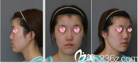 在北京米揚(yáng)麗格做隆鼻面部脂肪填充前樣子 在北京米揚(yáng)麗格做隆鼻面部脂肪填充前樣子