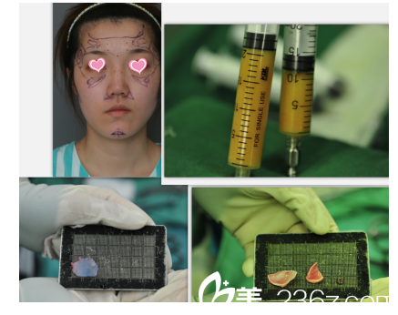 北京米揚(yáng)麗格做隆鼻脂肪填充當(dāng)天樣子 北京米揚(yáng)麗格做隆鼻脂肪填充當(dāng)天樣子