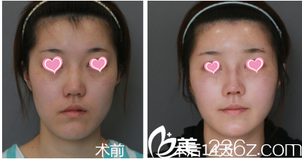 巫文云鼻綜合面部脂肪填充案例術(shù)前與第14天效果 巫文云鼻綜合面部脂肪填充案例術(shù)前與第14天效果