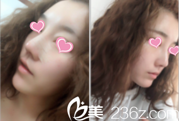 北京米揚(yáng)麗格鼻綜合面部脂肪填充案例 北京米揚(yáng)麗格鼻綜合面部脂肪填充案例