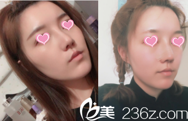 看北京米揚(yáng)麗格巫文云夏正義聯(lián)合給我打造鼻綜合面部脂肪填充效果朋友說靠譜