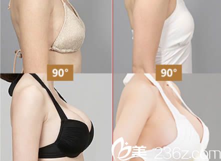 廣州曙光整形醫(yī)院劉杰偉胸部整形案例圖