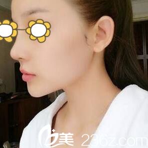 鼻綜合術(shù)后一周拆線 鼻綜合術(shù)后一周拆線