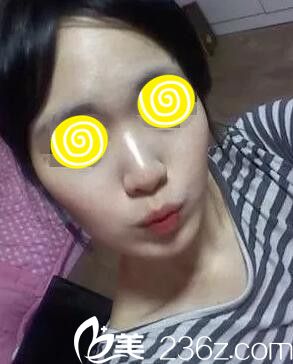 鼻整形術(shù)前照 鼻整形術(shù)前照