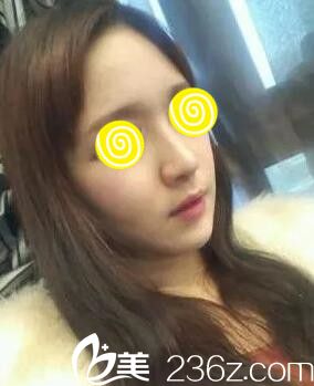 鼻整形半個(gè)月 鼻整形半個(gè)月