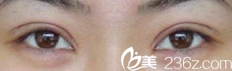 崔相錄醫(yī)生全切雙眼皮恢復(fù)后案例 崔相錄醫(yī)生全切雙眼皮恢復(fù)后案例