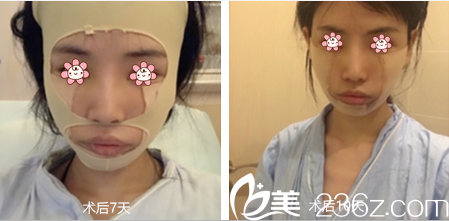 在韓國JSTAR整形外科做完手術(shù)差不多快半個(gè)月了 在韓國JSTAR整形外科做完手術(shù)差不多快半個(gè)月了