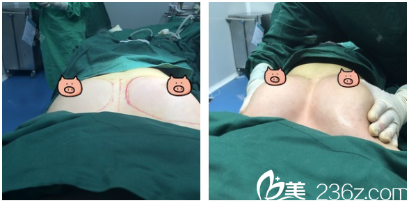 深圳<!--<i data=20240703-sp></i>-->賈維順自體脂肪豐胸術(shù)前術(shù)后對比 深圳<!--<i data=20240703-sp></i>-->賈維順自體脂肪豐胸術(shù)前術(shù)后對比