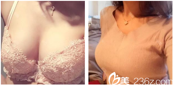 一個月前我在深圳博愛曙光醫(yī)院賈維順醫(yī)生的建議下做了自體脂肪豐胸